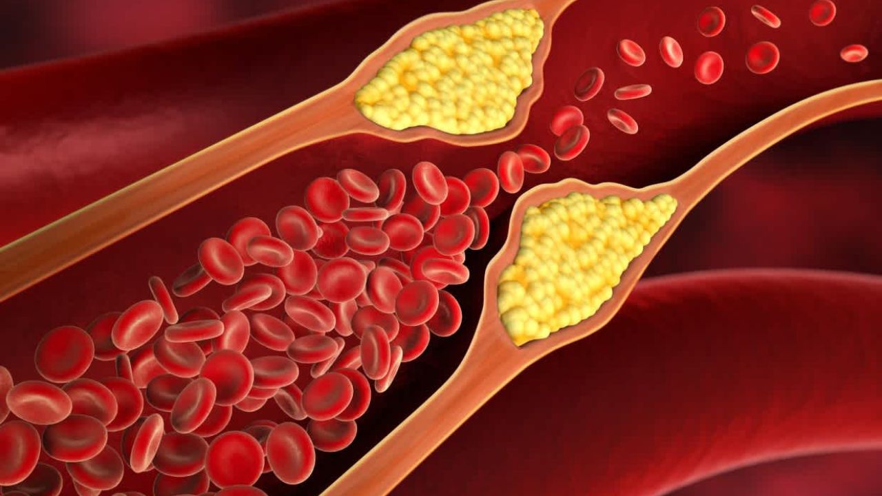 High Cholesterol Management: The Role of Walking in Reducing Bad Fats